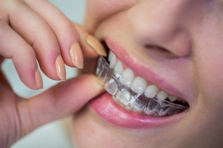 Sorriso metálico é substituído por tecnologia invisível com eficácia no alinhamento dentário